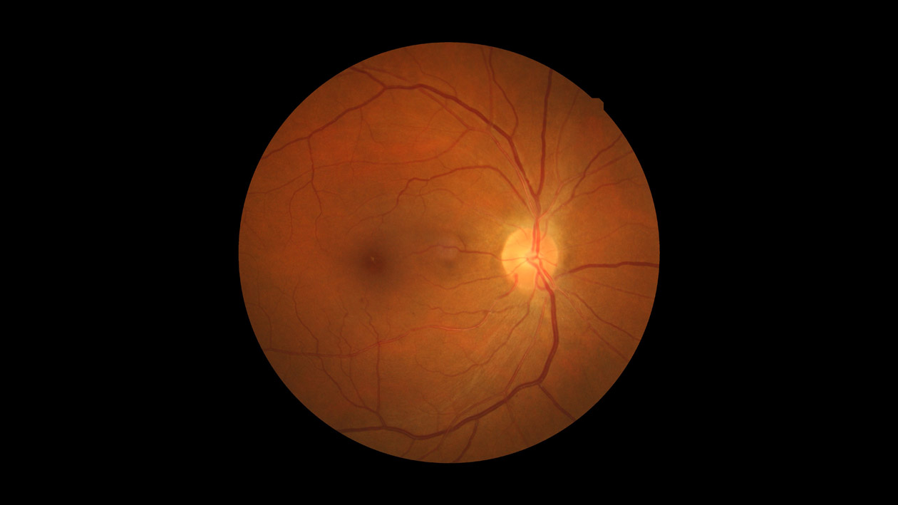 Hypertensive Retinopathy